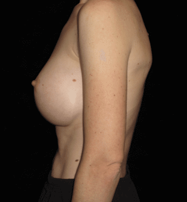 Breast Augmentation Patient Photo - Case 10125 - after view-2