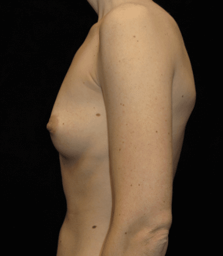 Breast Augmentation Patient Photo - Case 10125 - before view-2