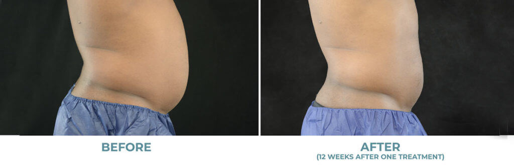 EON Body Contouring Nashville Before and After Results