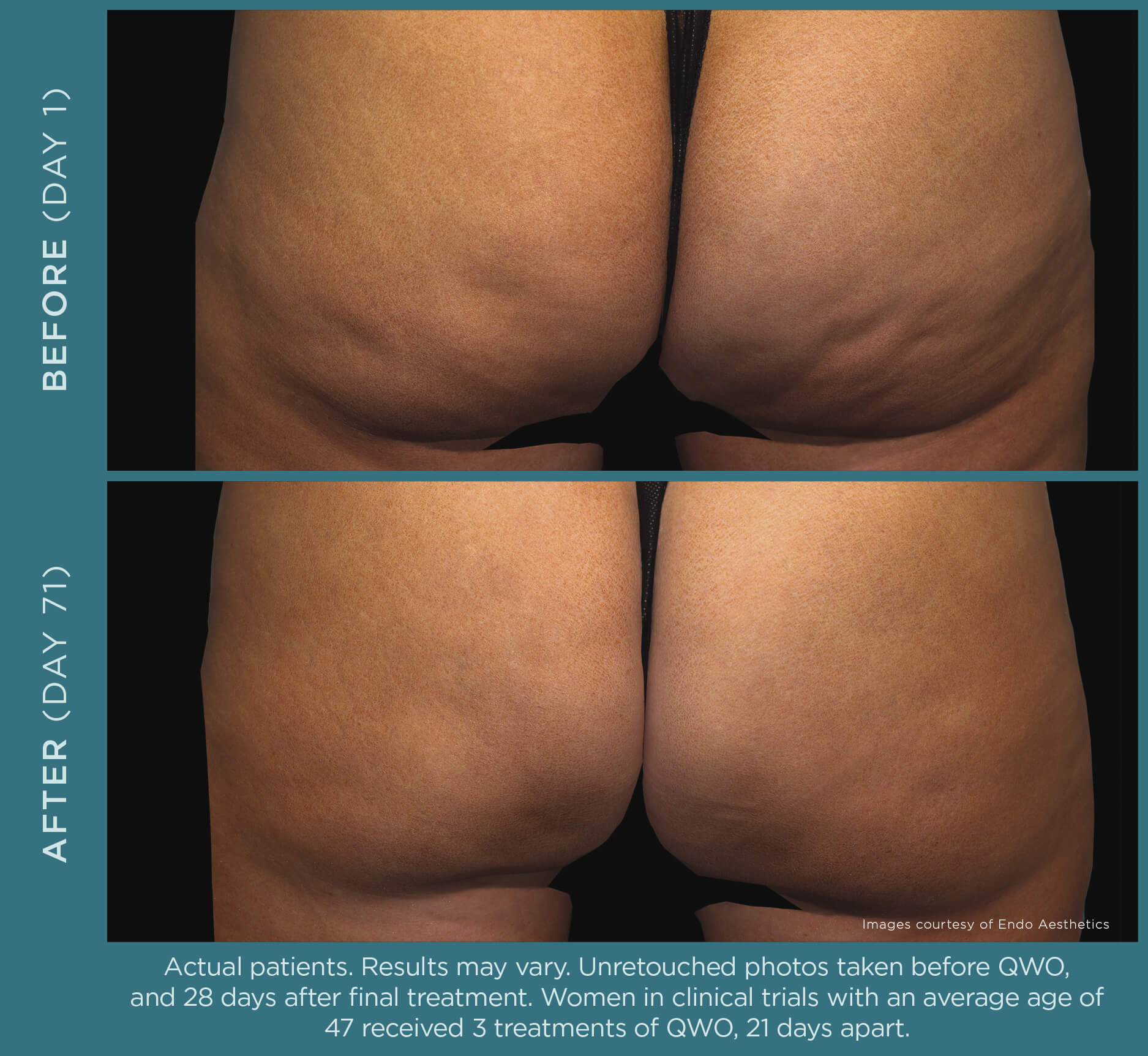 Before and After QWO Cellulite Reduction