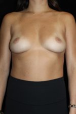 Breast Augmentation before and after results - Nashville patient - Before