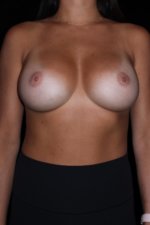 Breast Augmentation before and after results - Nashville patient - After