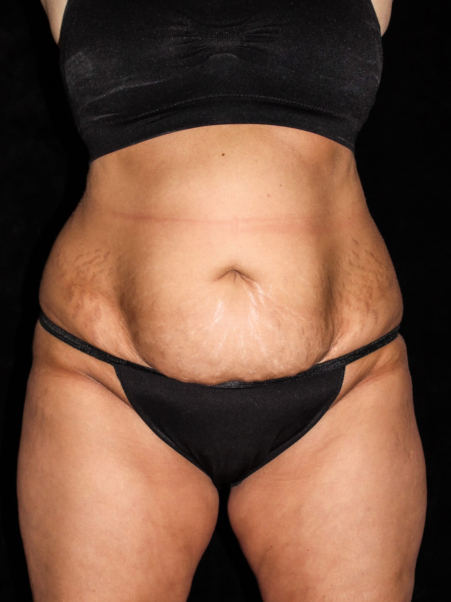 Tummy Tuck Patient Photo - Case 14823 - before view-