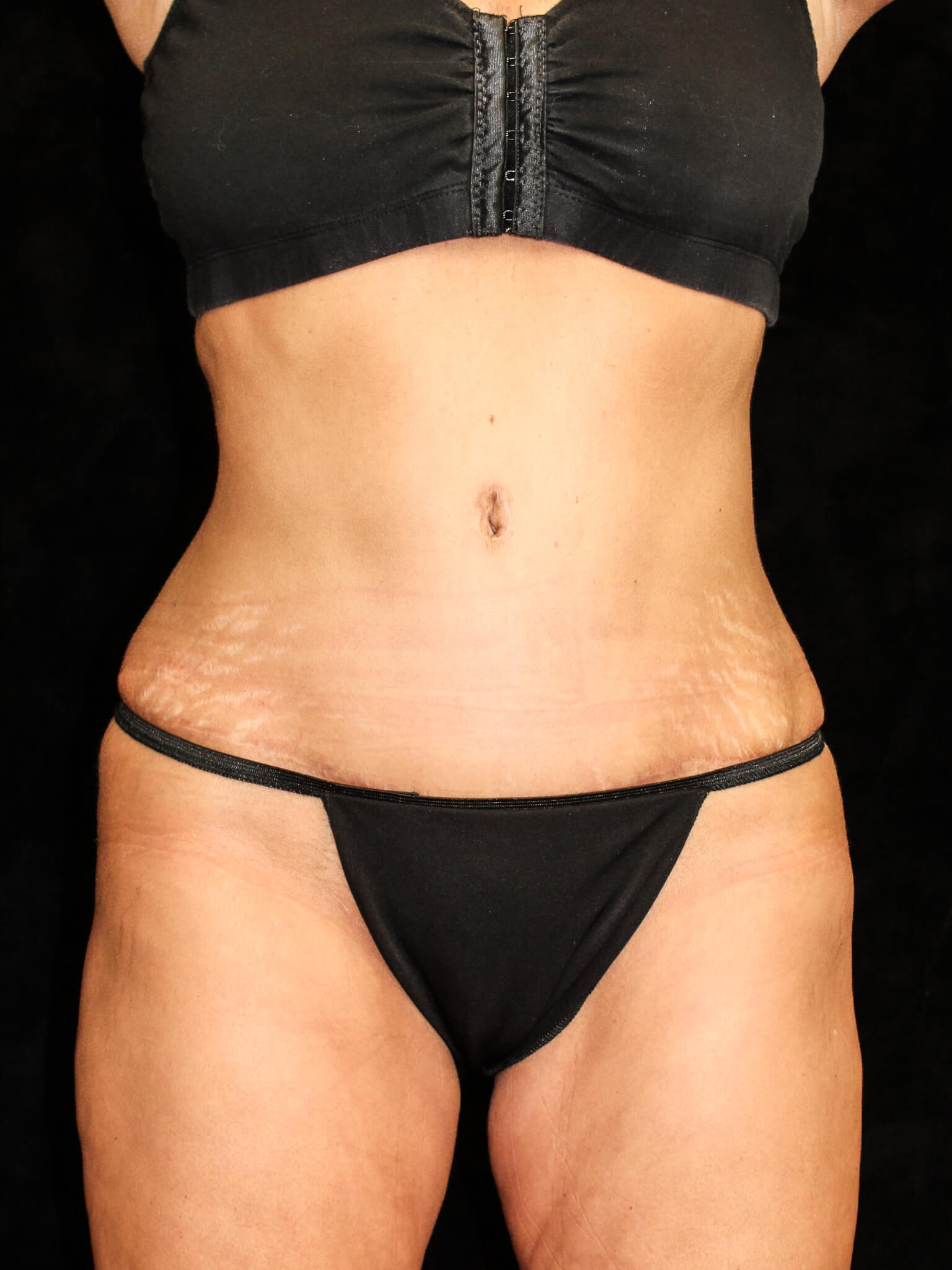Tummy Tuck Patient Photo - Case 14823 - after view