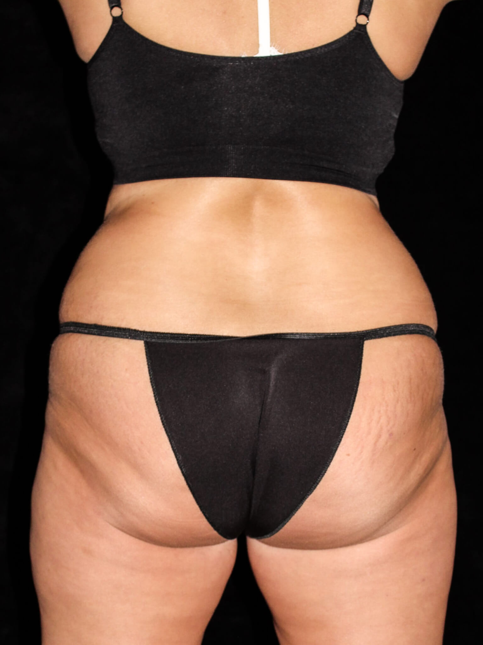 Tummy Tuck Patient Photo - Case 14823 - before view-2