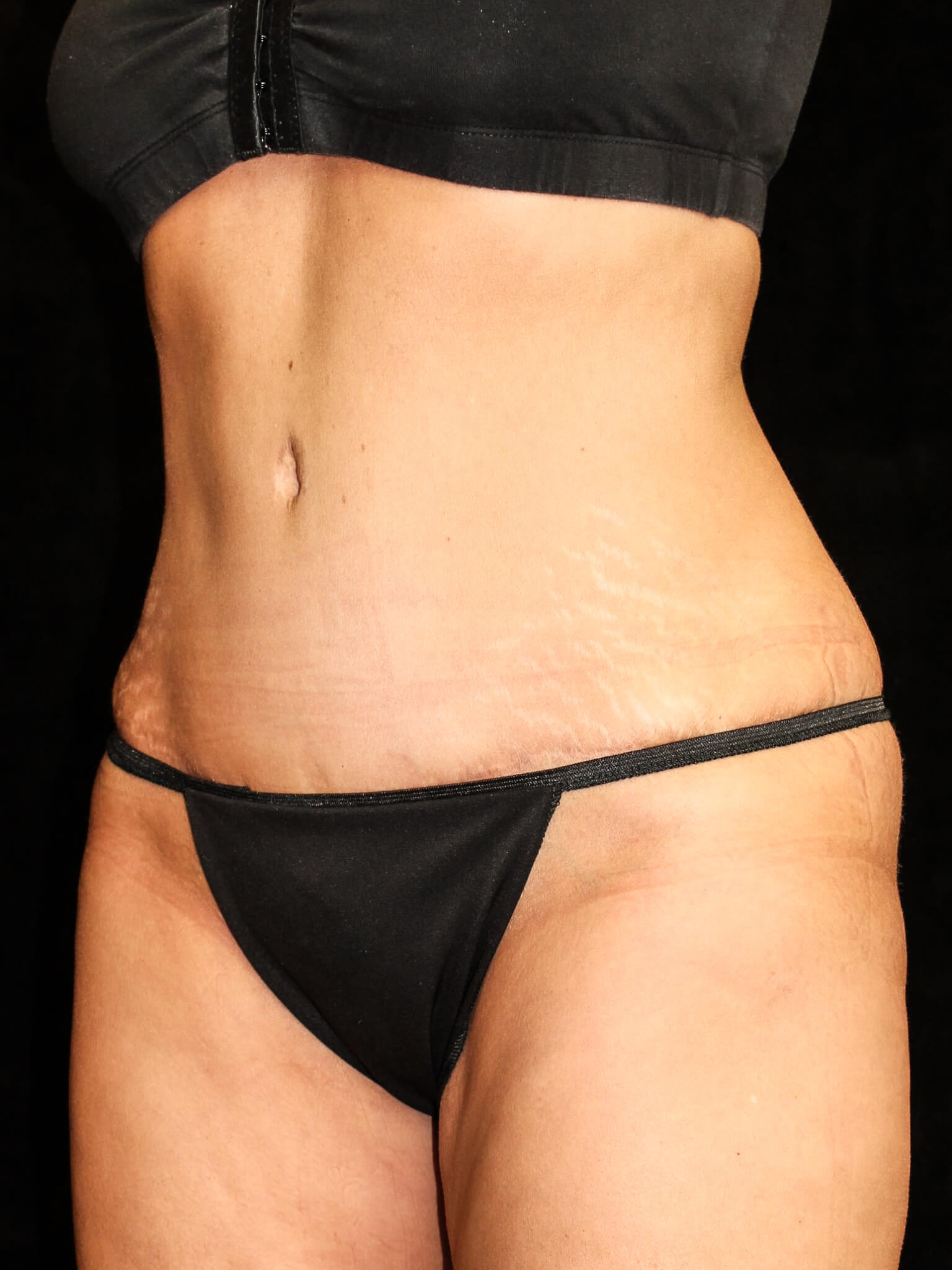 Tummy Tuck Patient Photo - Case 14823 - after view-1