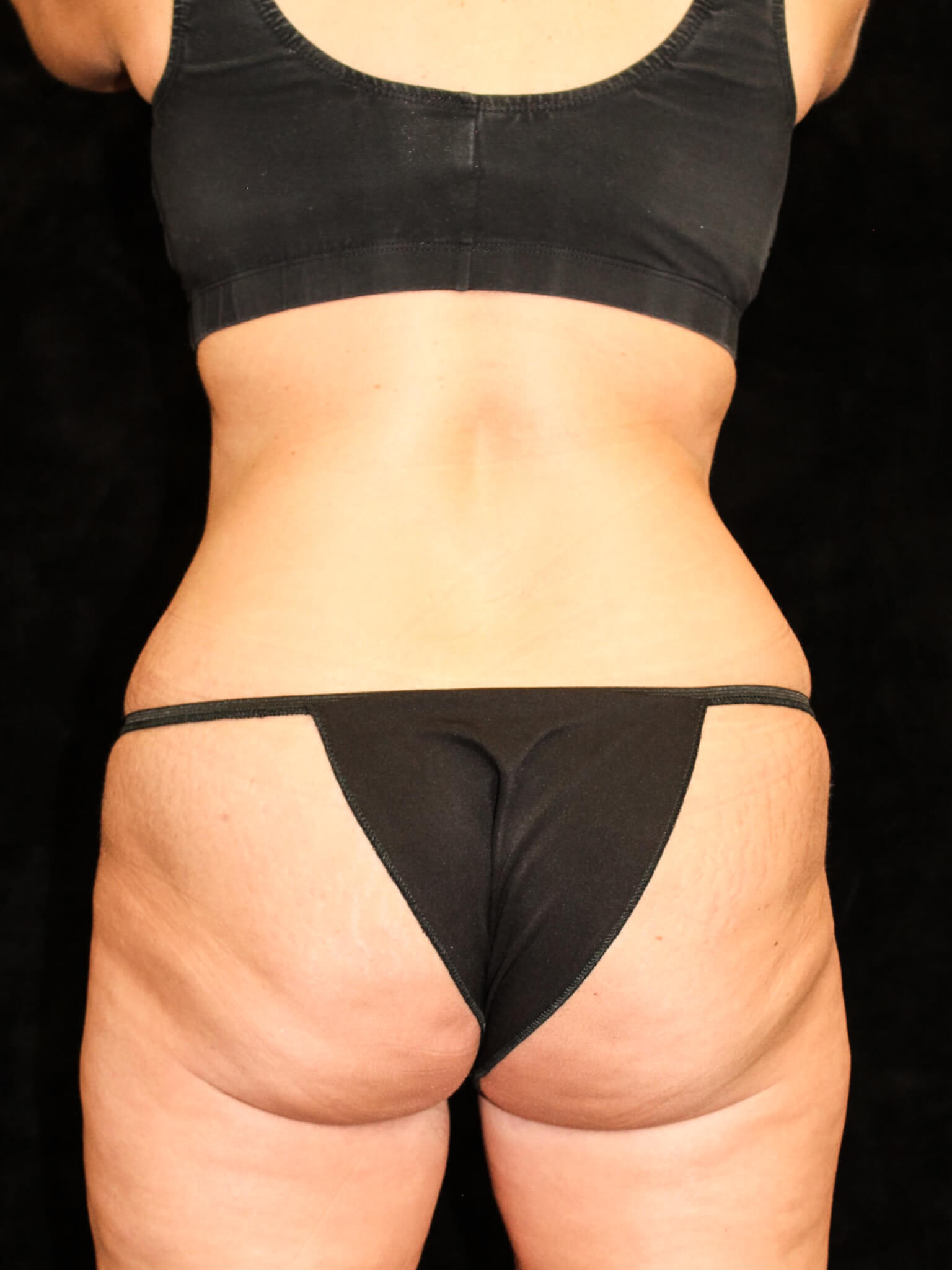 Tummy Tuck Patient Photo - Case 14823 - after view-2