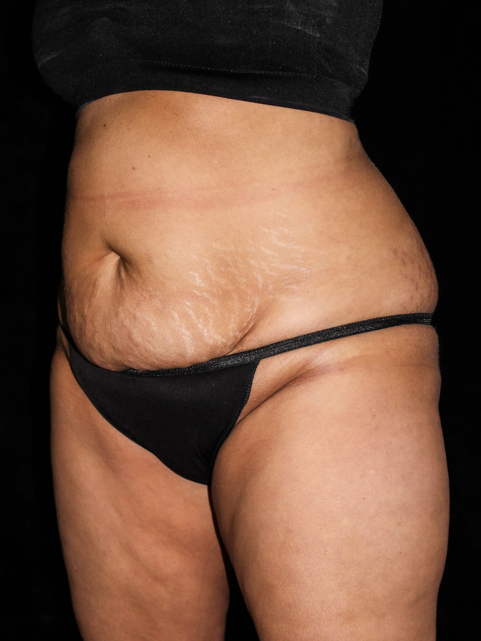 Tummy Tuck Patient Photo - Case 14823 - before view-1