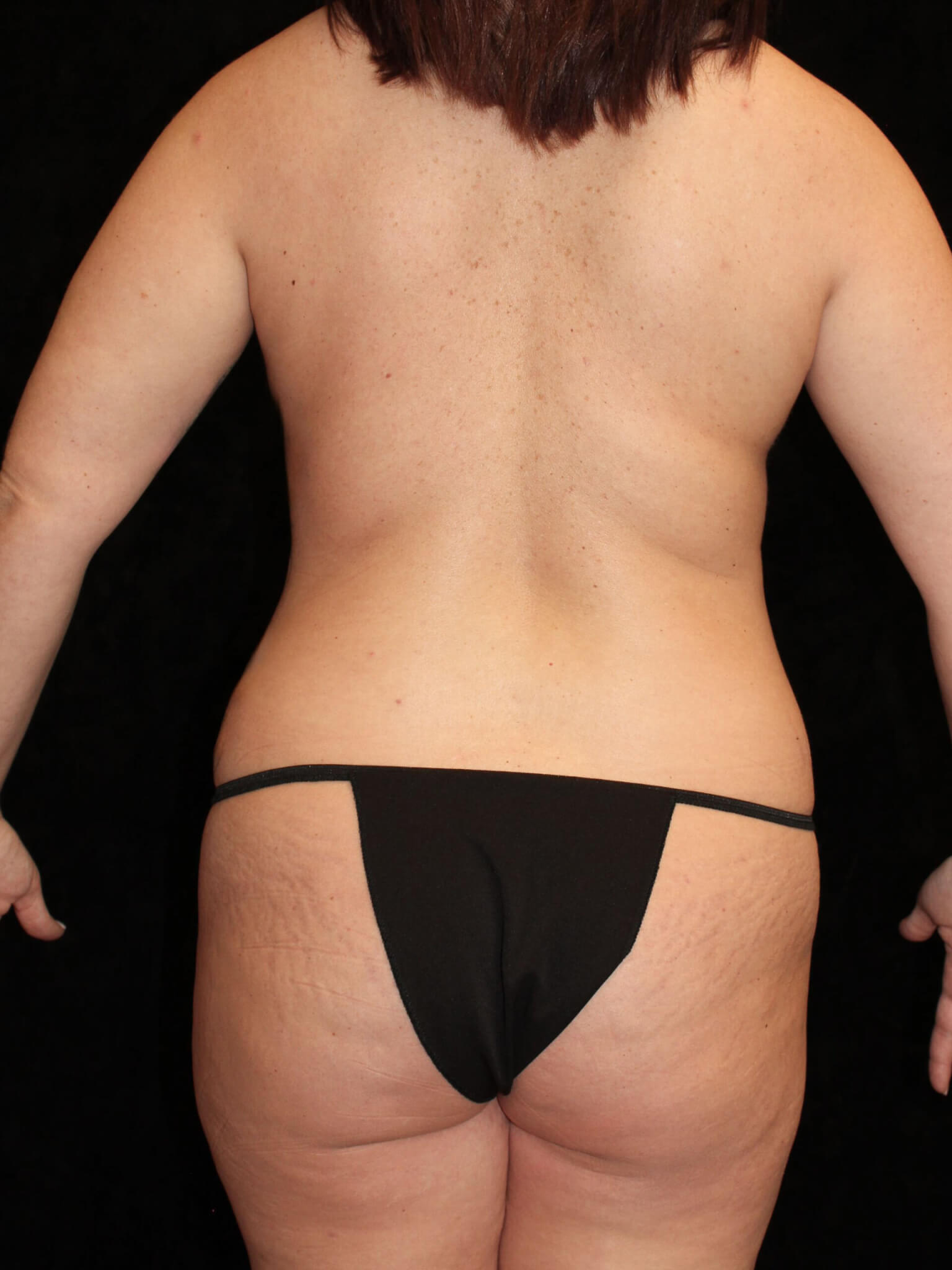 Mommy Makeover Patient Photo - Case 15530 - before view-3