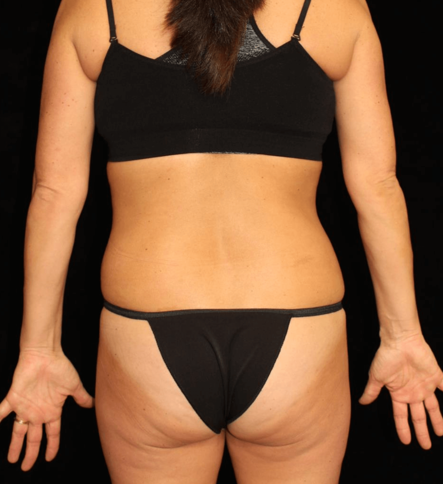 Liposuction Patient Photo - Case 12890 - before view-3