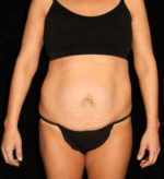 Liposuction before and after results - Nashville patient - Before