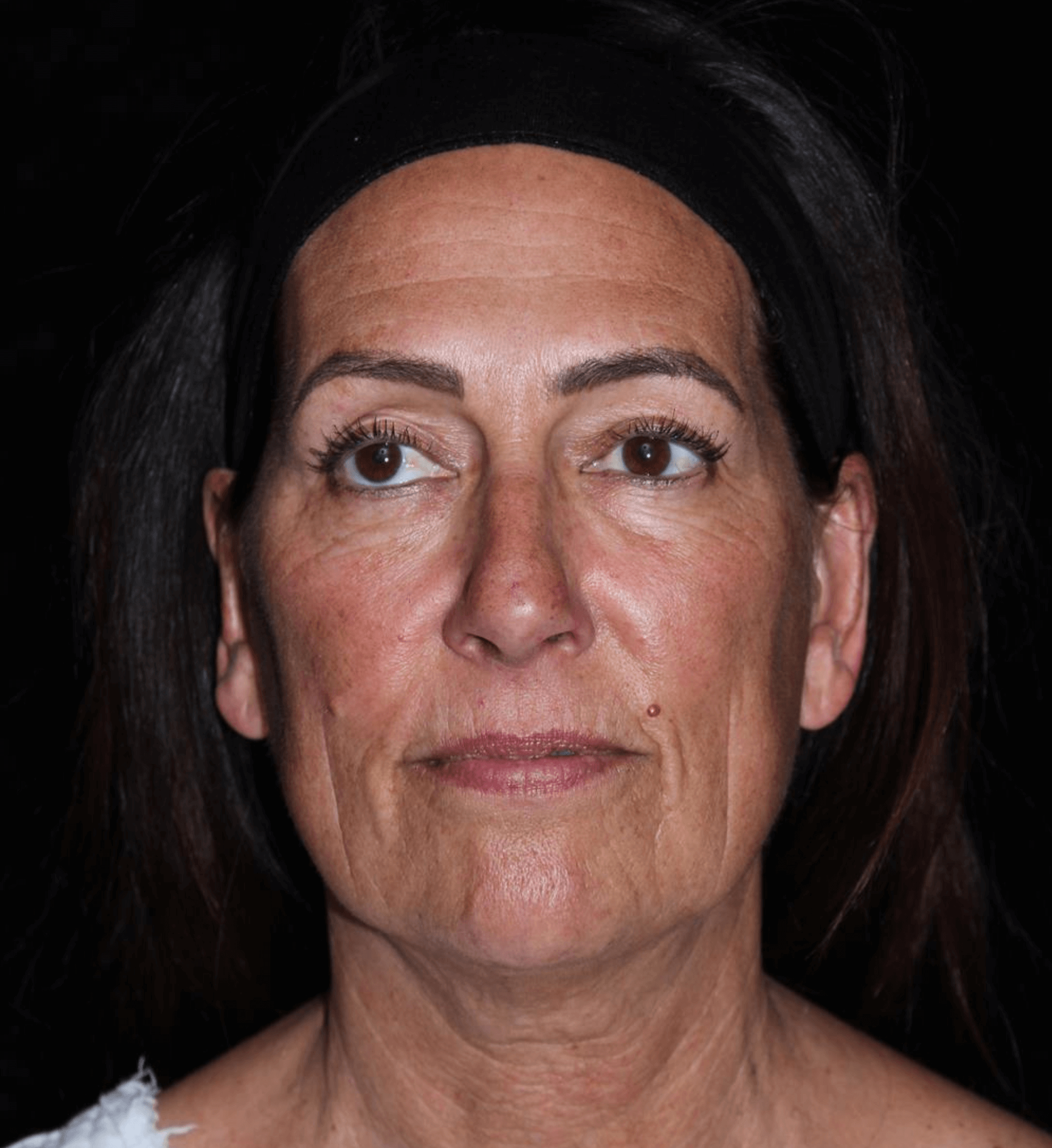 Eyelid Surgery Patient Photo - Case 8940 - before view-