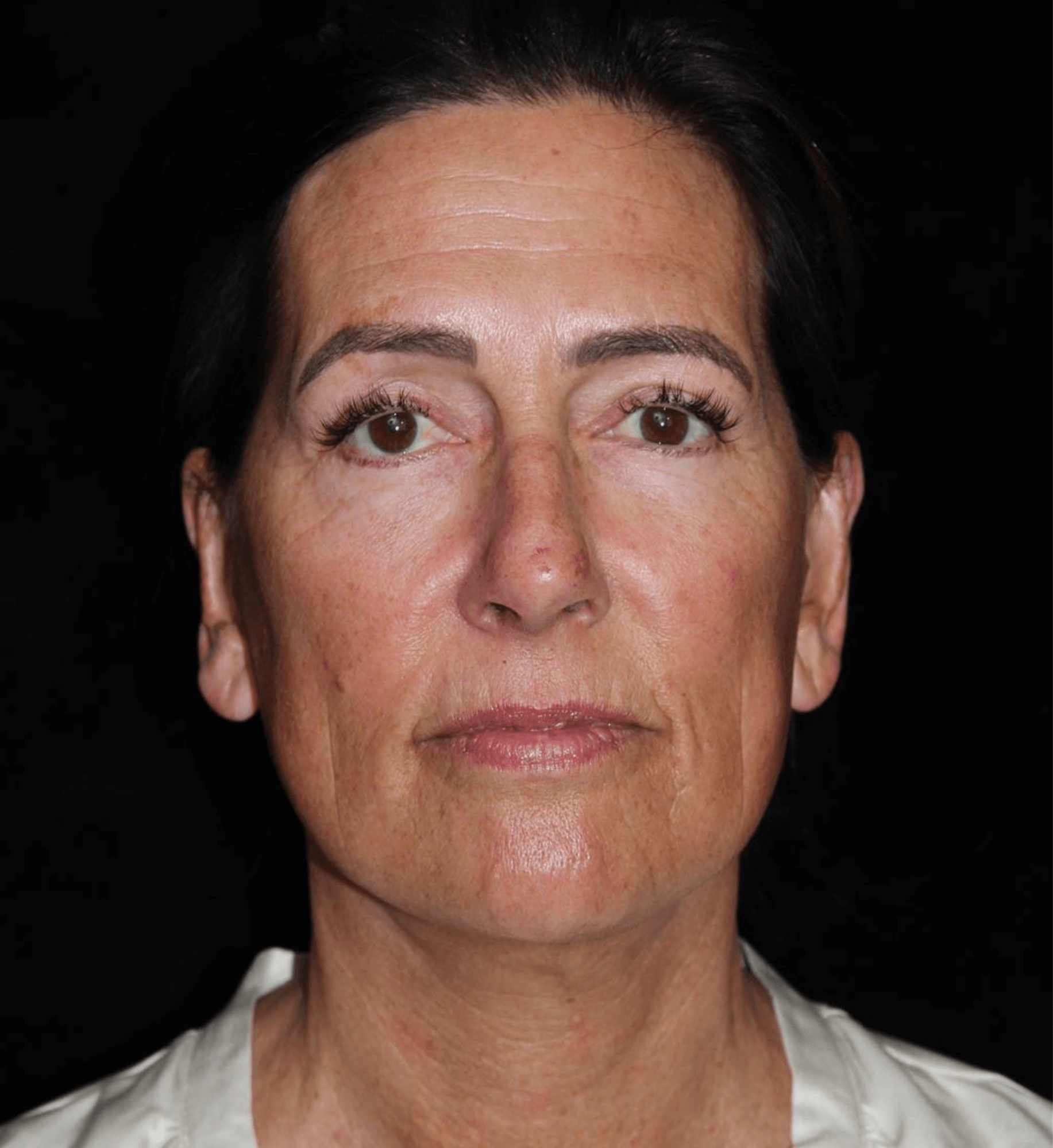 Eyelid Surgery Patient Photo - Case 8940 - after view