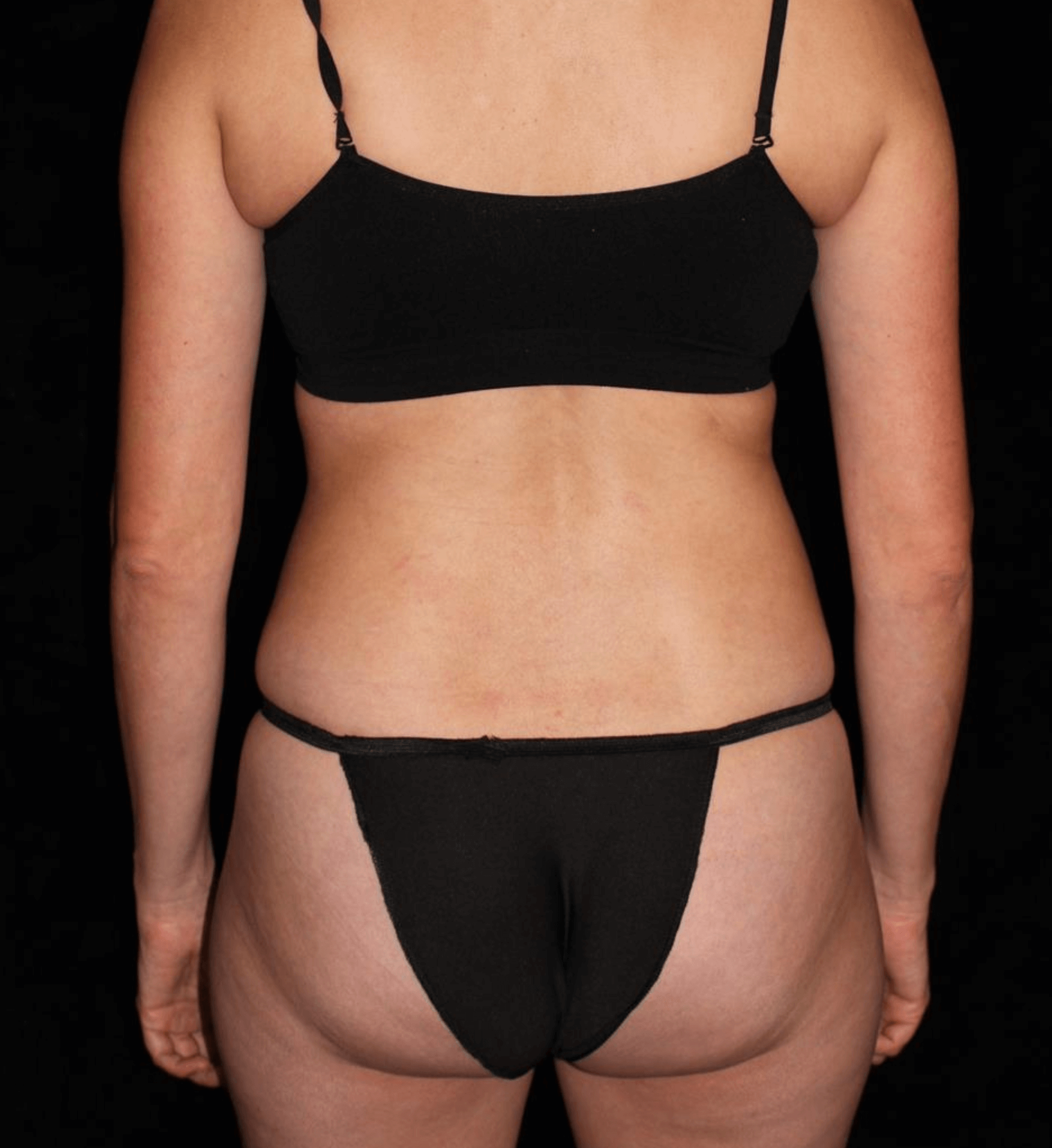 Liposuction Patient Photo - Case 13418 - after view-3