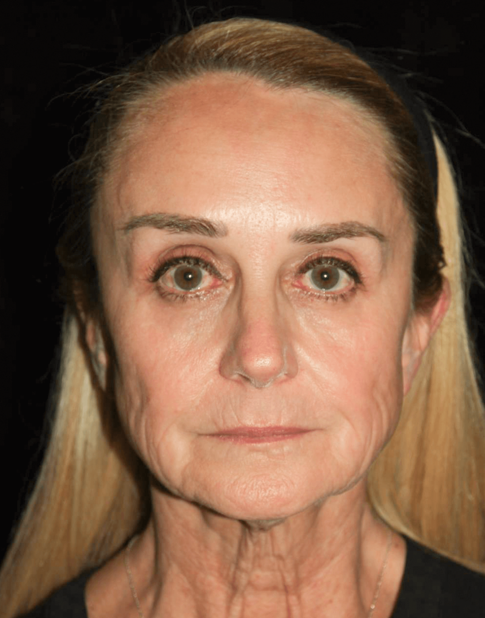 Facelift Patient Photo - Case 5332 - before view-