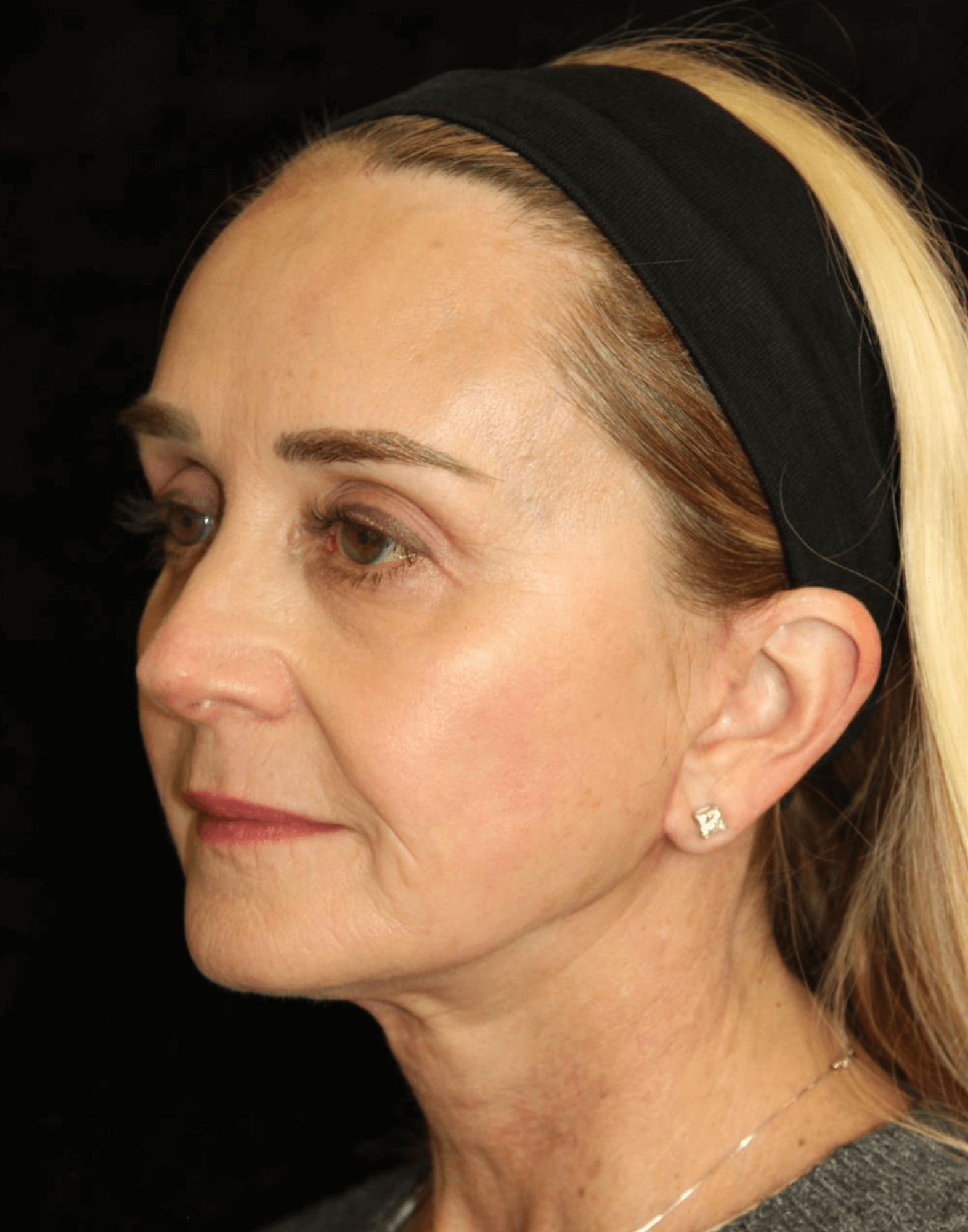 Facelift Patient Photo - Case 5332 - after view-1