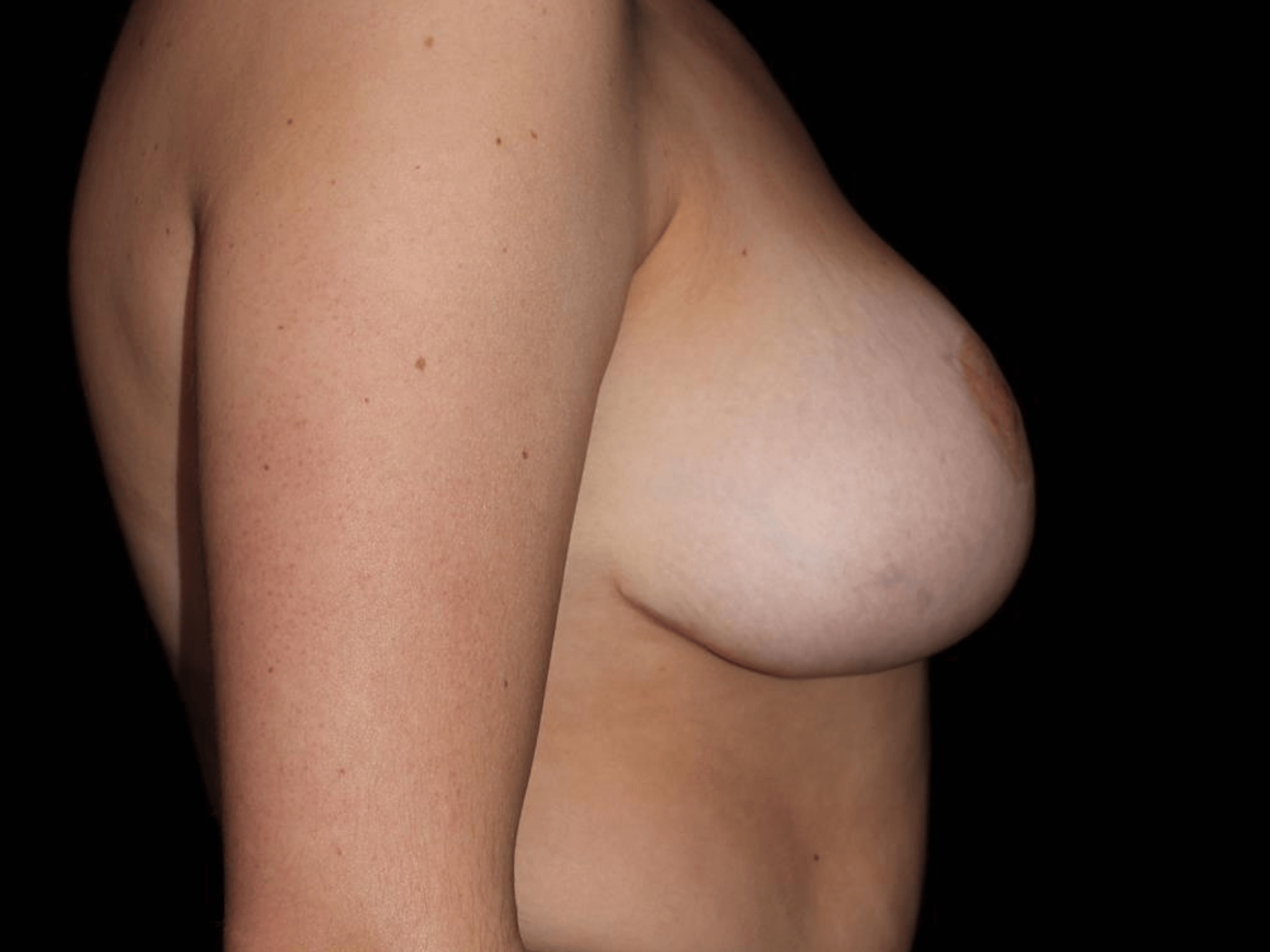 Breast Asymmetry before and after results - Nashville patient - after view 3