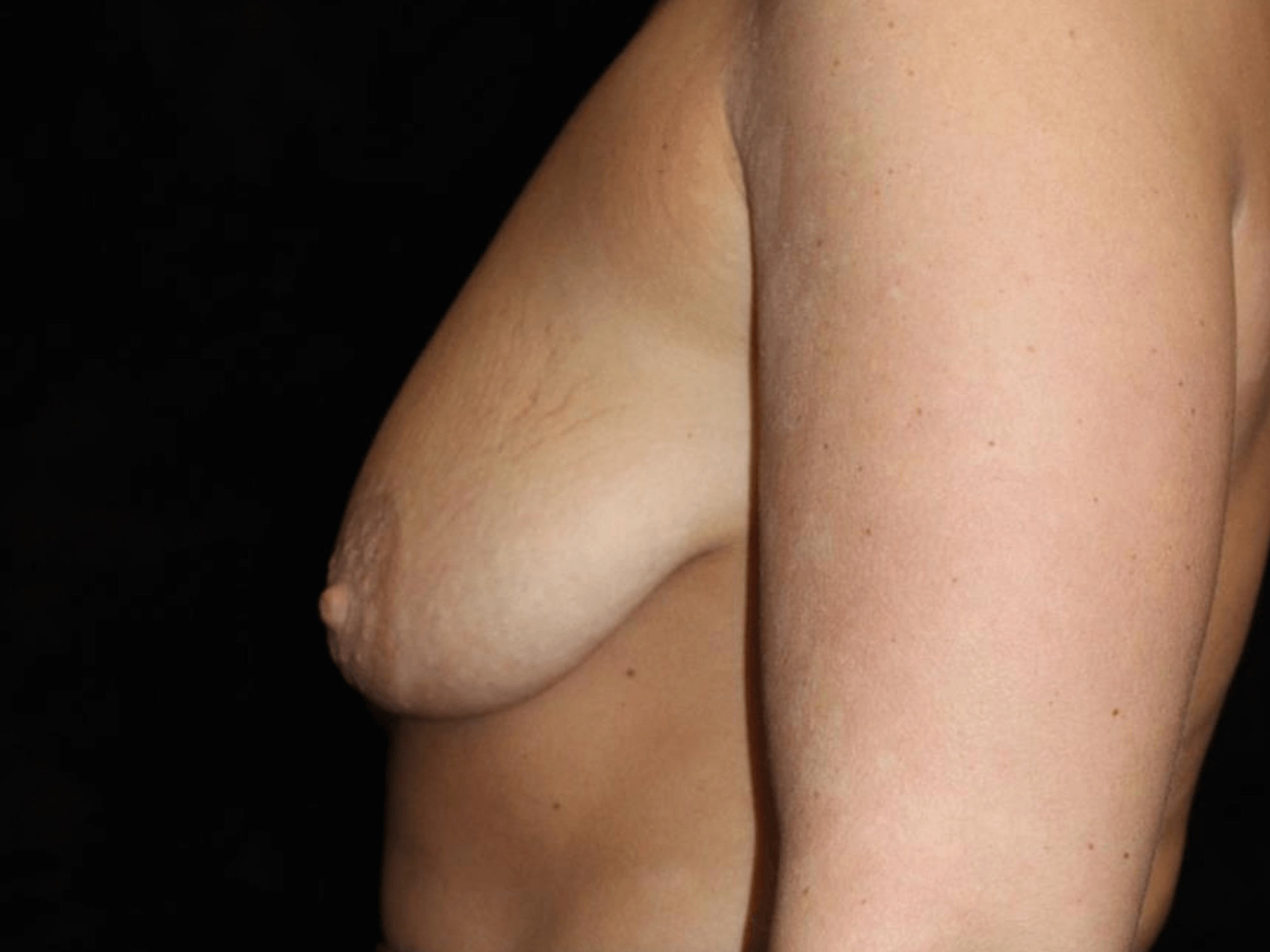 Breast Asymmetry Patient Photo - Case 16170 - before view-1