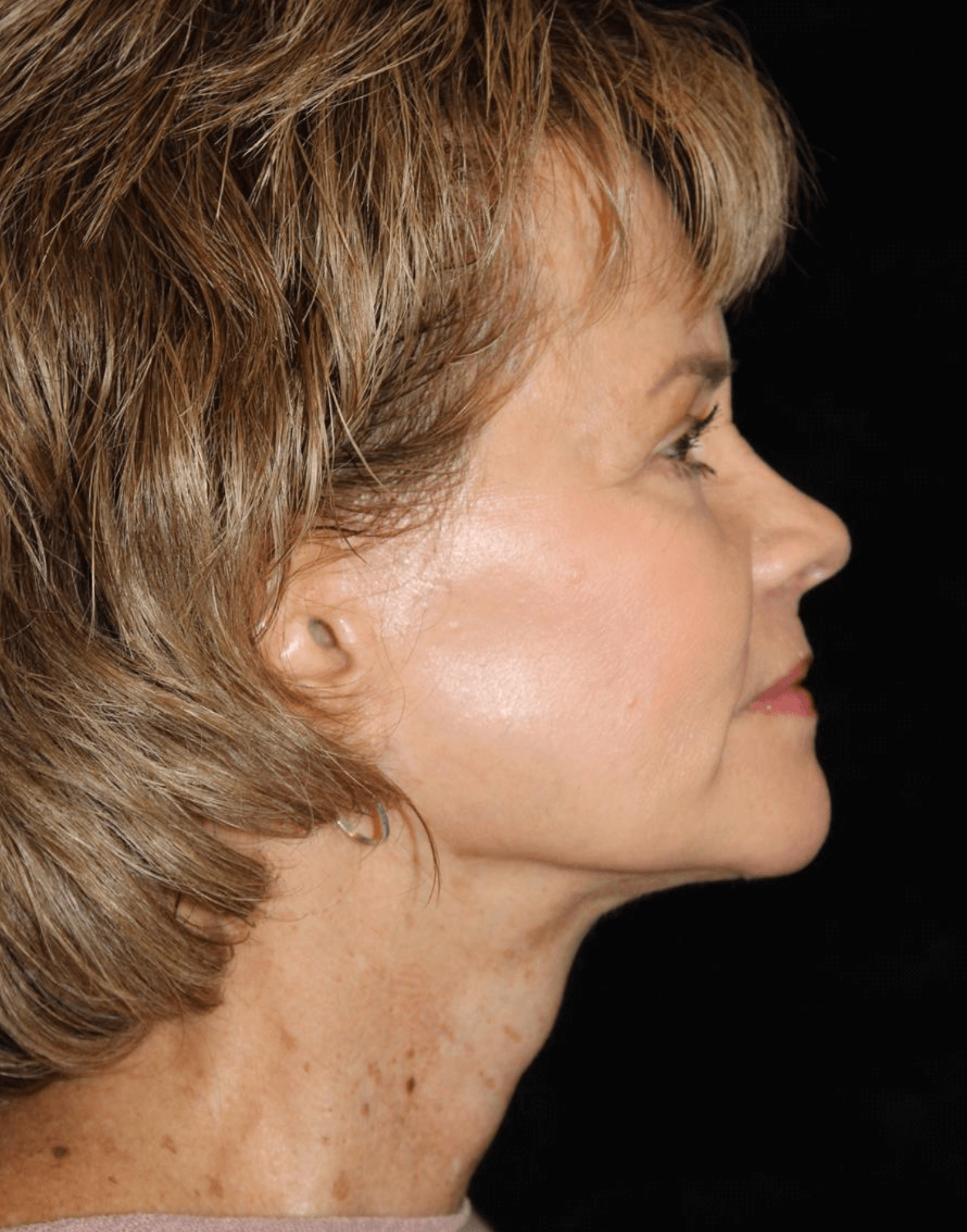 Facelift Patient Photo - Case 17235 - after view-2