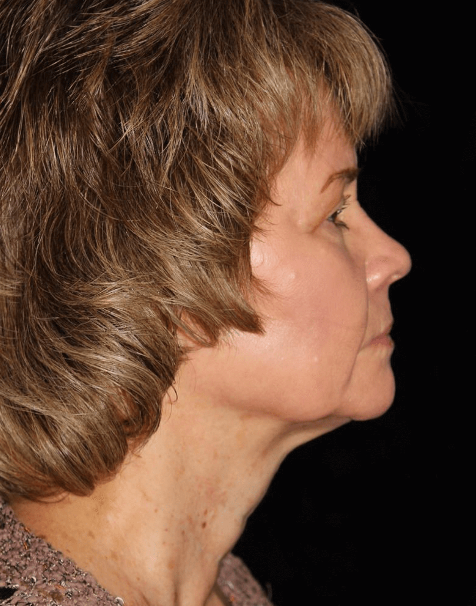 Facelift Patient Photo - Case 17235 - before view-2