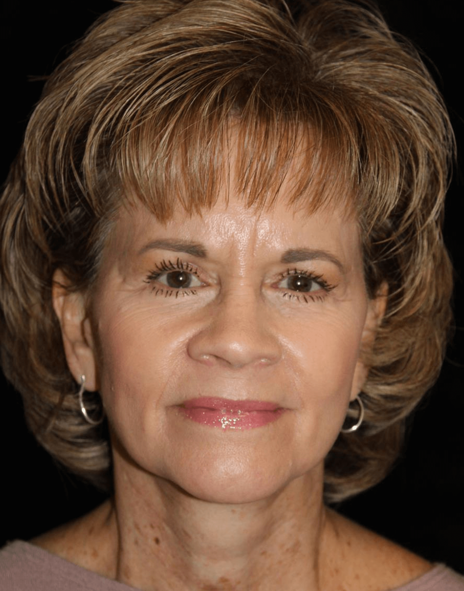 Facelift Patient Photo - Case 17235 - after view