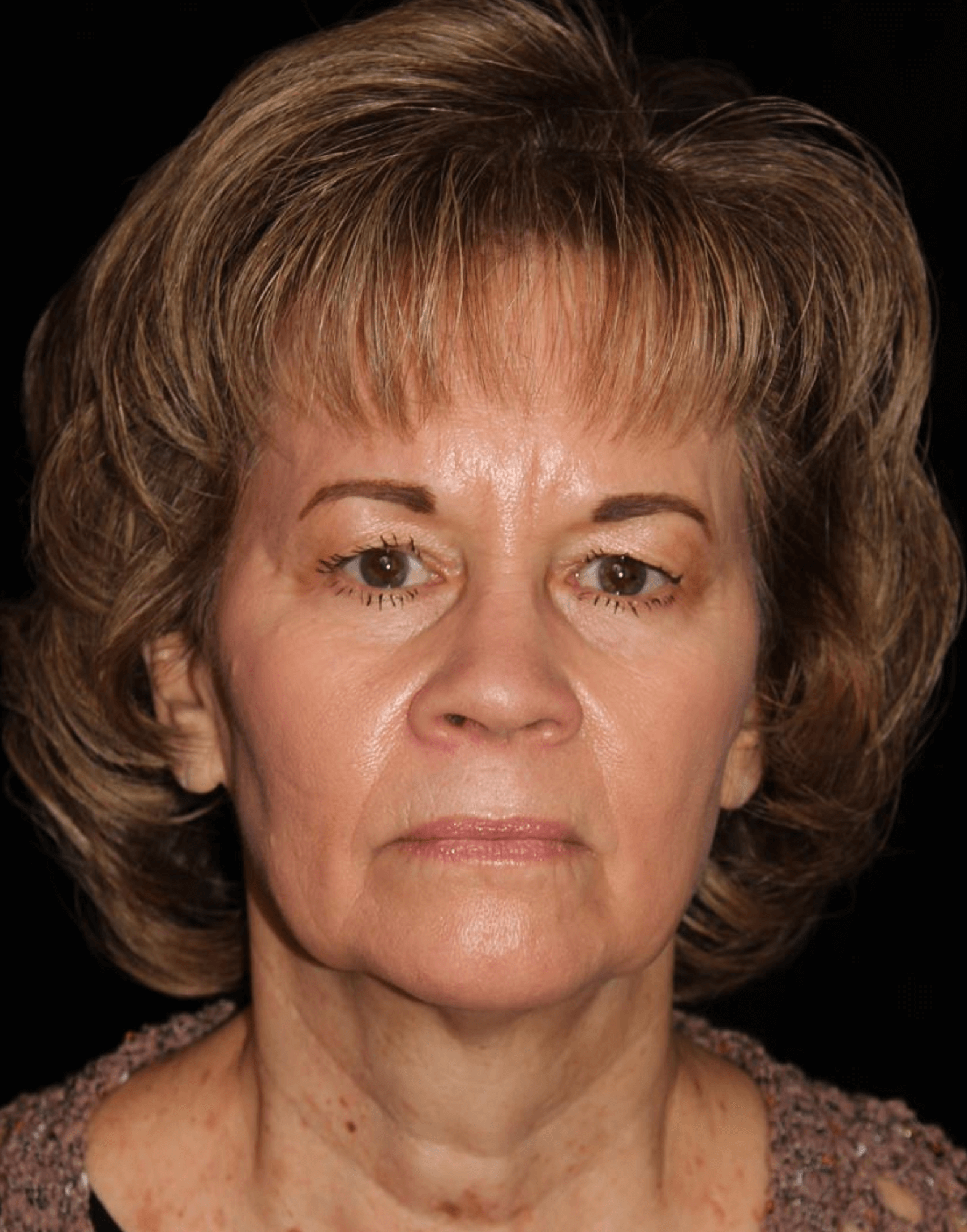 Eyelid Surgery Patient Photo - Case 17235 - before view-