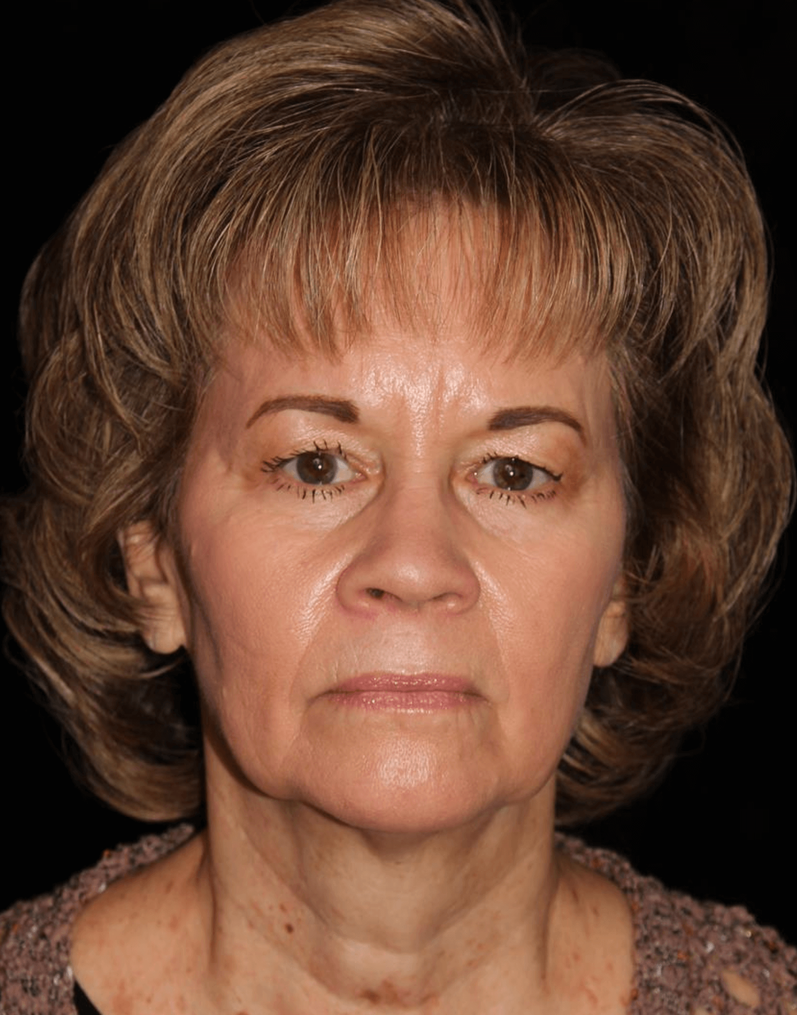 Facelift Patient Photo - Case 17235 - before view-