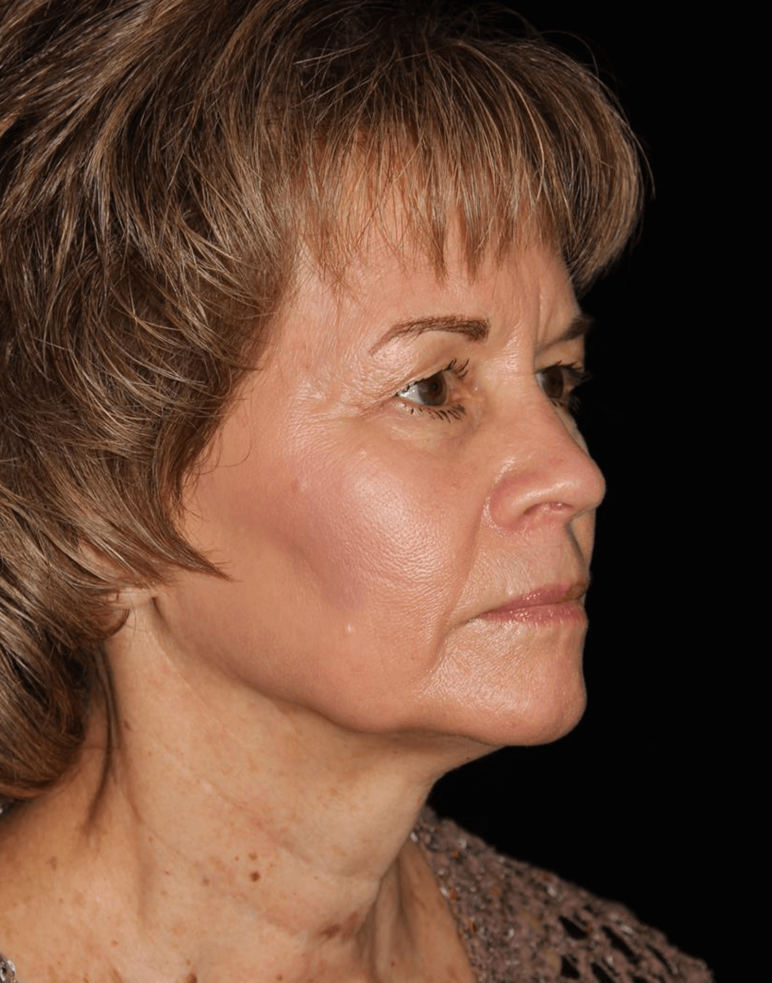Facelift Patient Photo - Case 17235 - before view-1