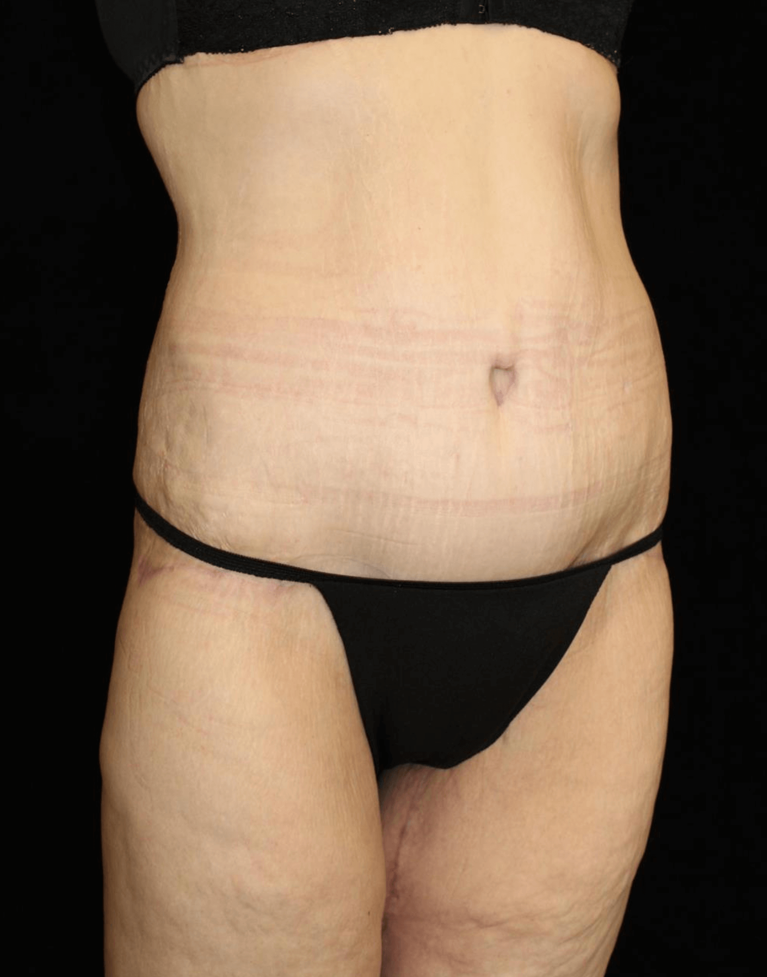 Body Lift Patient Photo - Case 17653 - after view-1