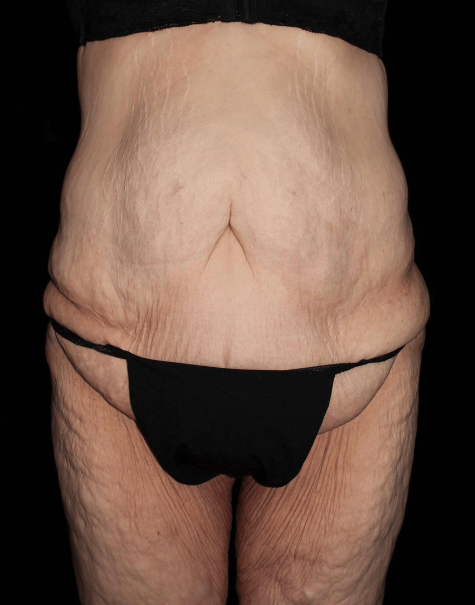 Body Lift Patient Photo - Case 17653 - before view-