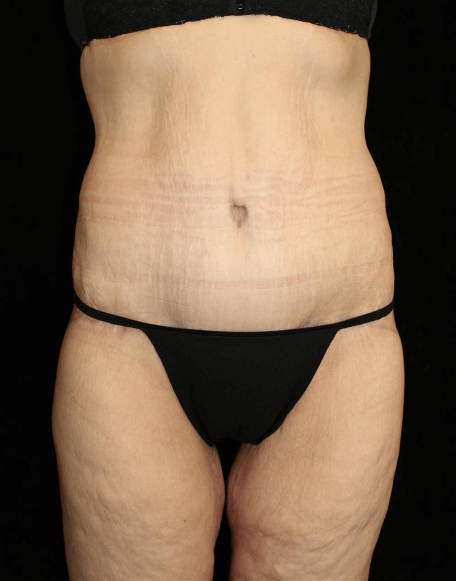Body Lift Patient Photo - Case 17653 - after view