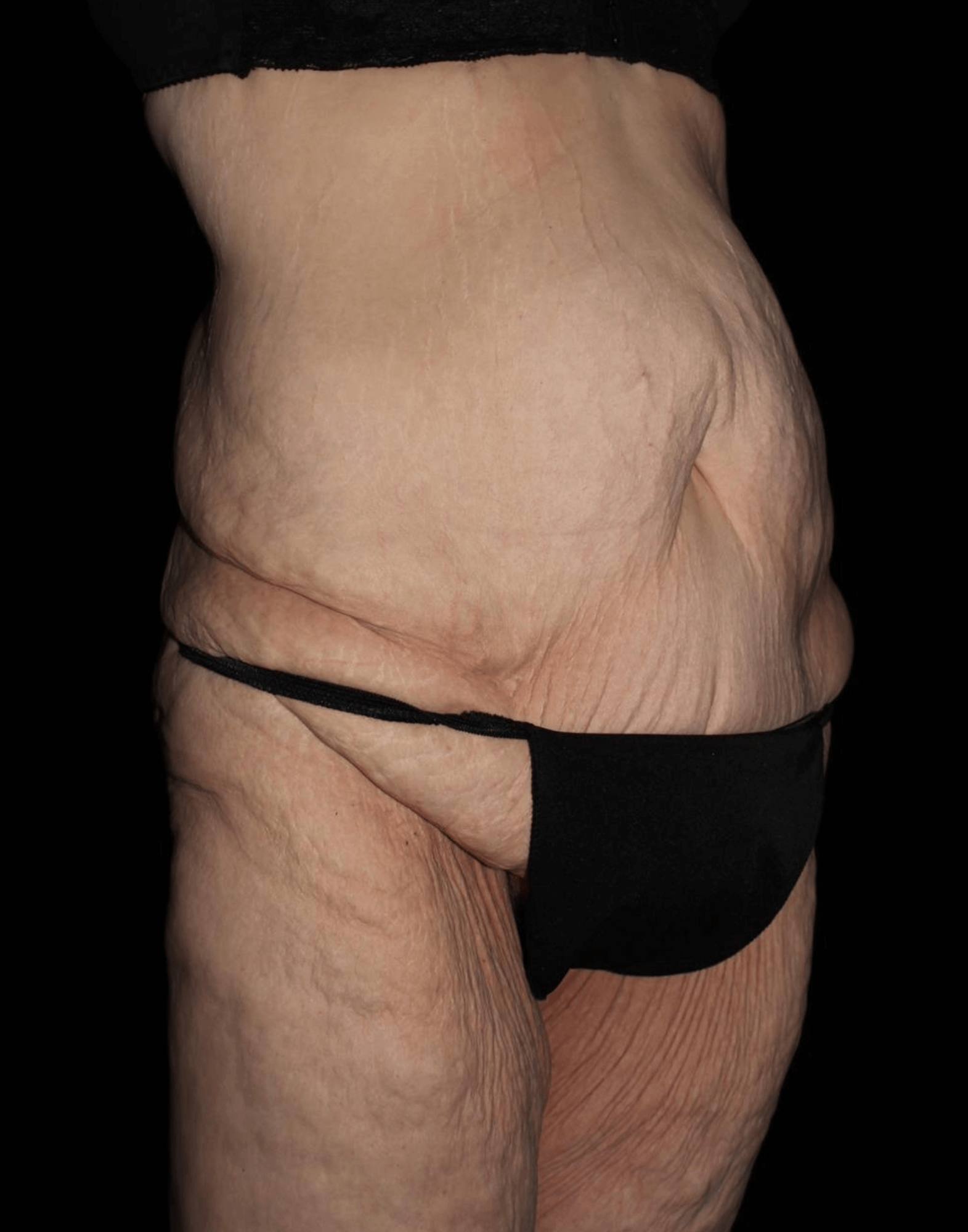 Body Lift Patient Photo - Case 17653 - before view-1