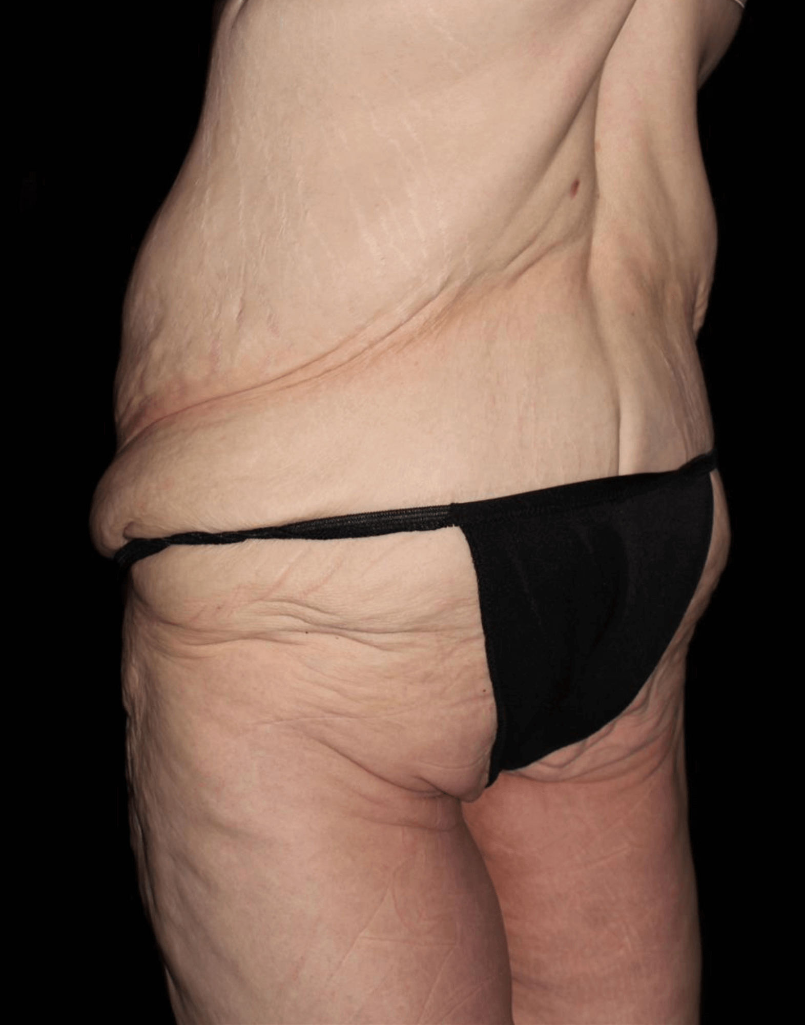 Body Lift Patient Photo - Case 17653 - before view-3