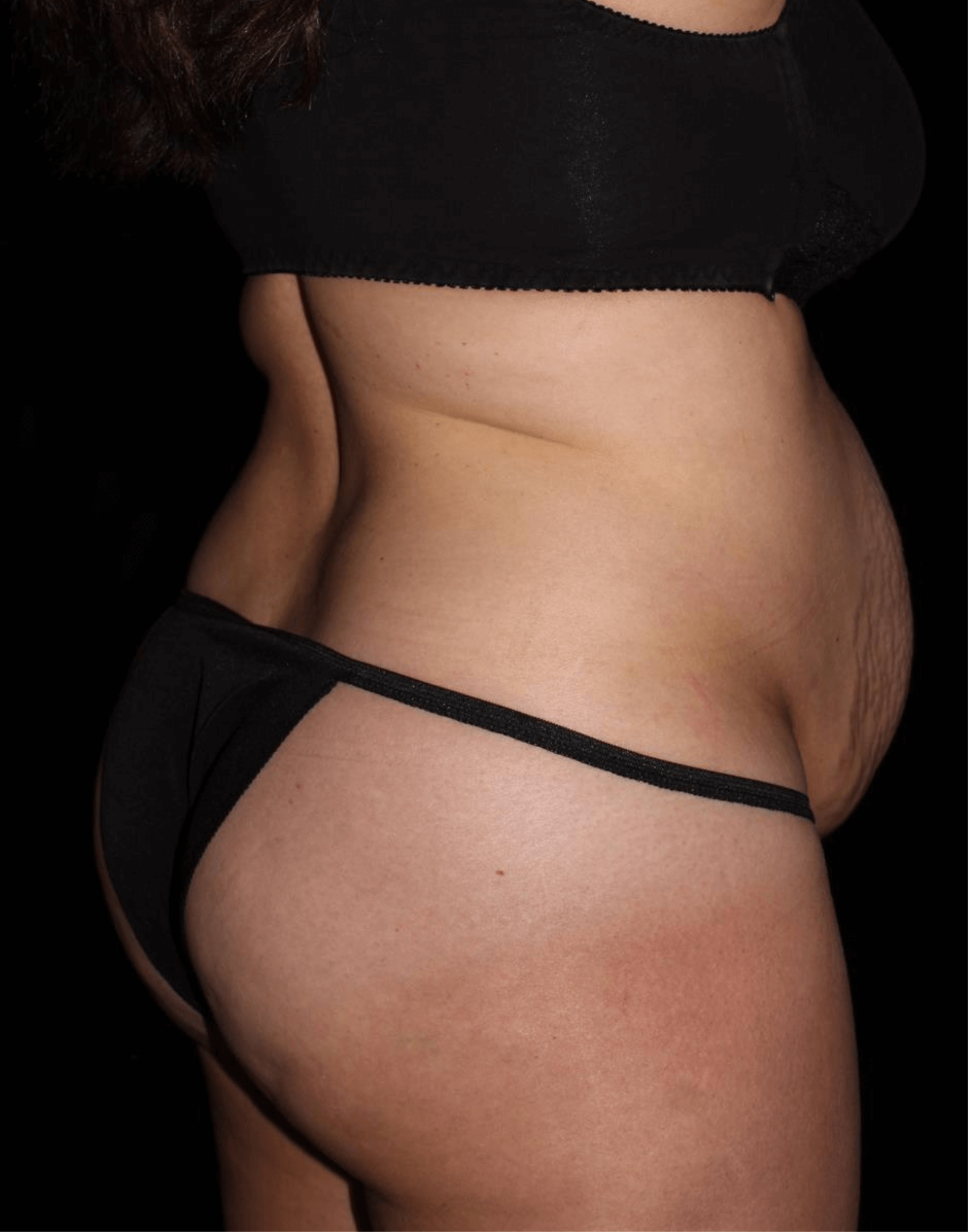 Tummy Tuck Patient Photo - Case 17012 - before view-3