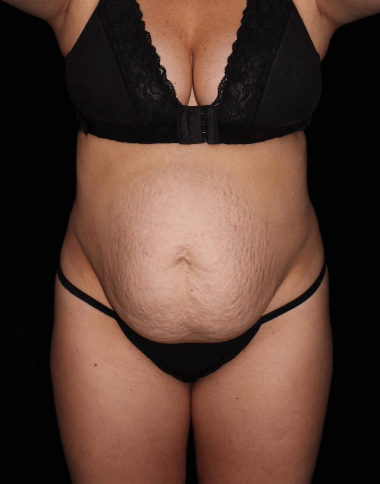 Tummy Tuck Patient Photo - Case 17012 - before view-