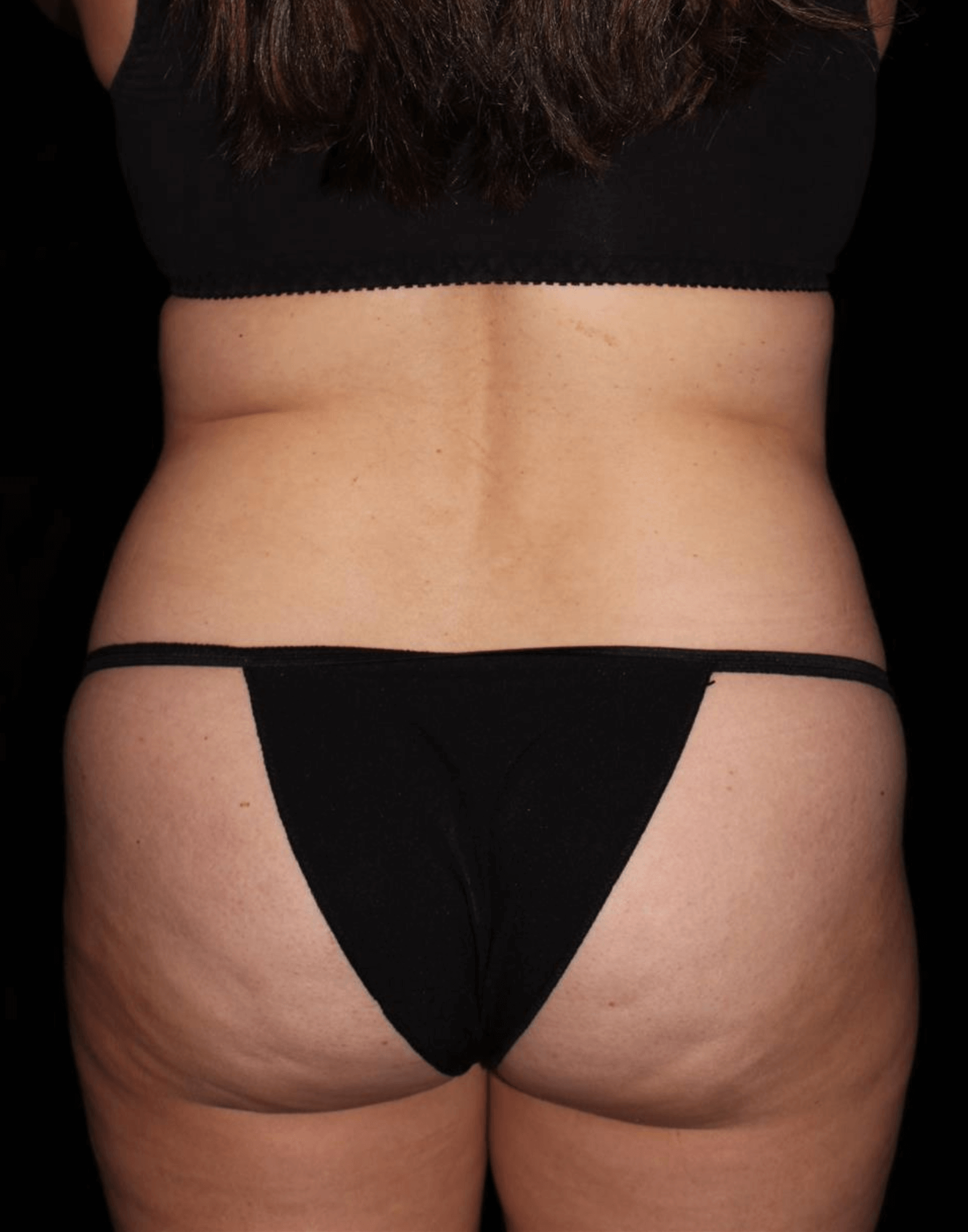Tummy Tuck Patient Photo - Case 17012 - before view-4