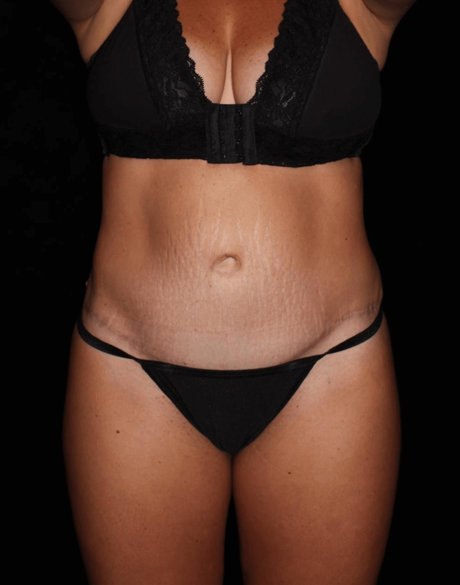 Tummy Tuck Patient Photo - Case 17012 - after view