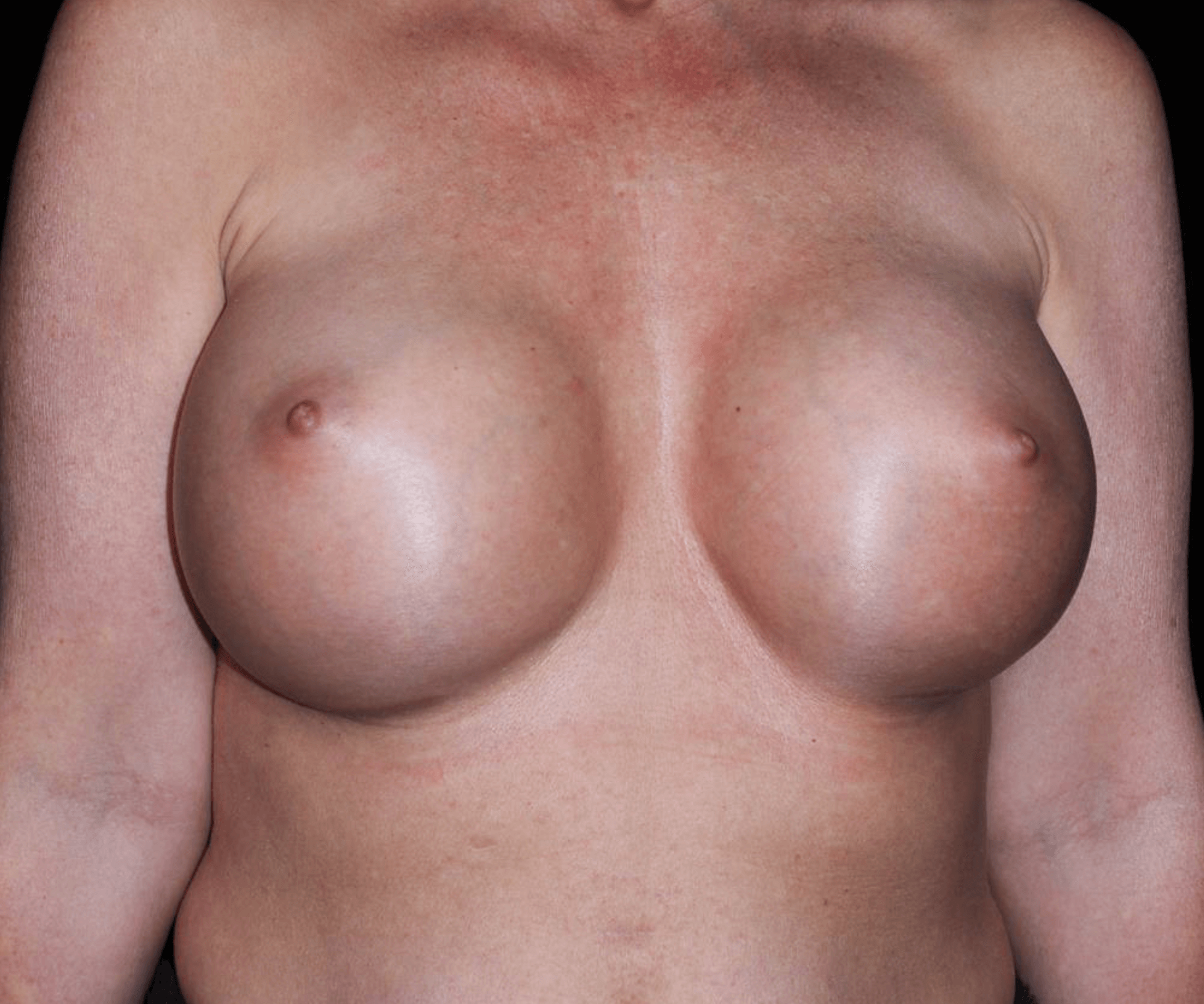 Breast Augmentation Patient Photo - Case 16028 - after view