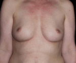 Breast Augmentation before and after results - Nashville patient - Before