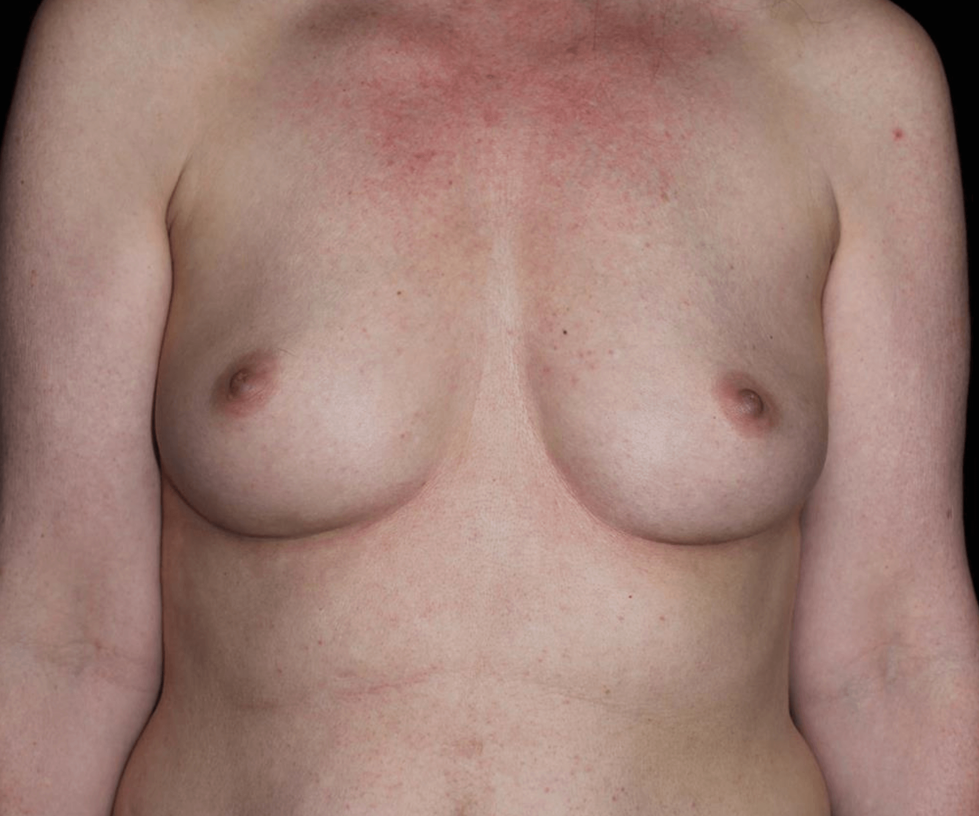 Breast Augmentation Patient Photo - Case 16028 - before view-