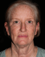 Eyelid Surgery - Case 17578 - Before