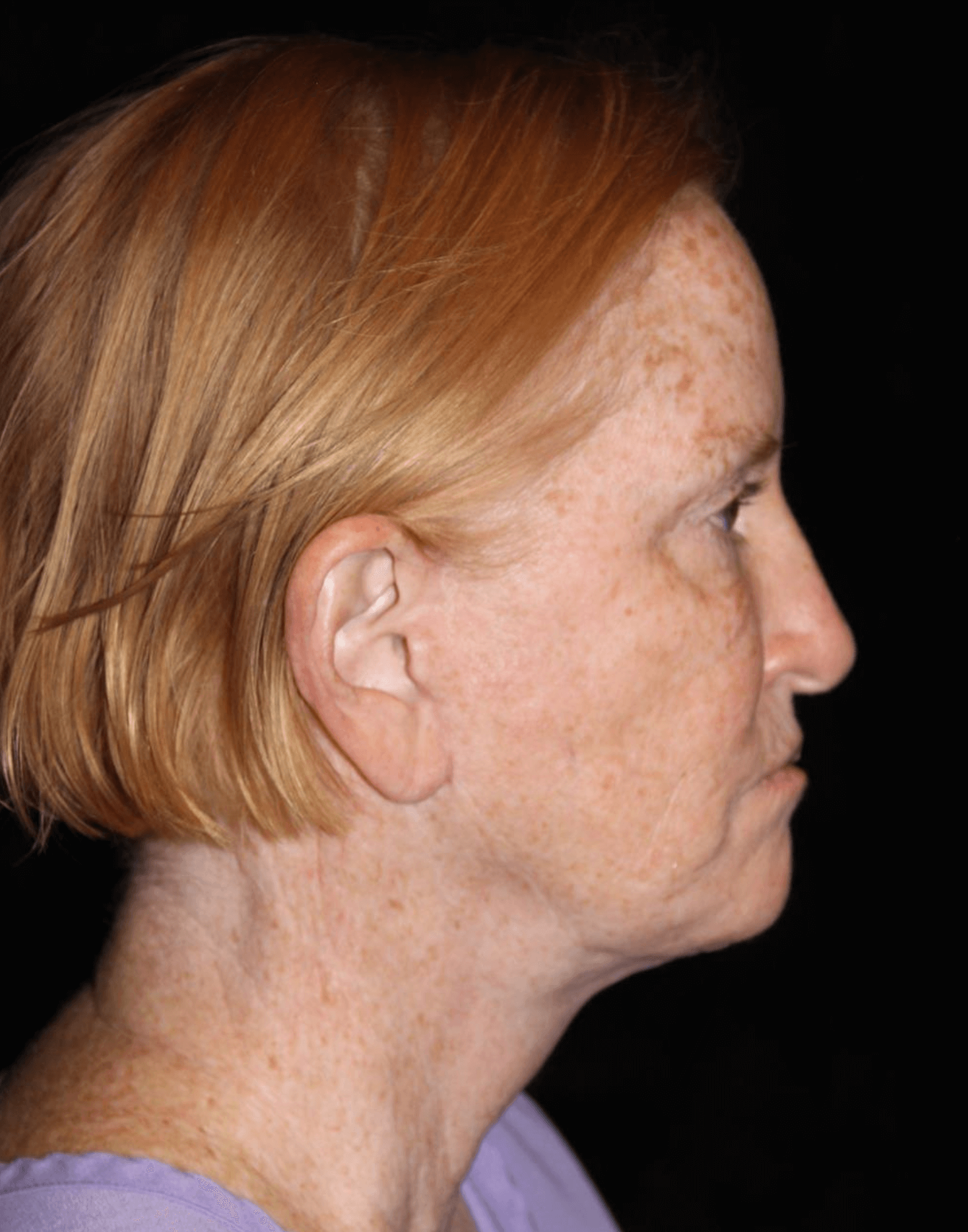 Eyelid Surgery Patient Photo - Case 17578 - after view-2