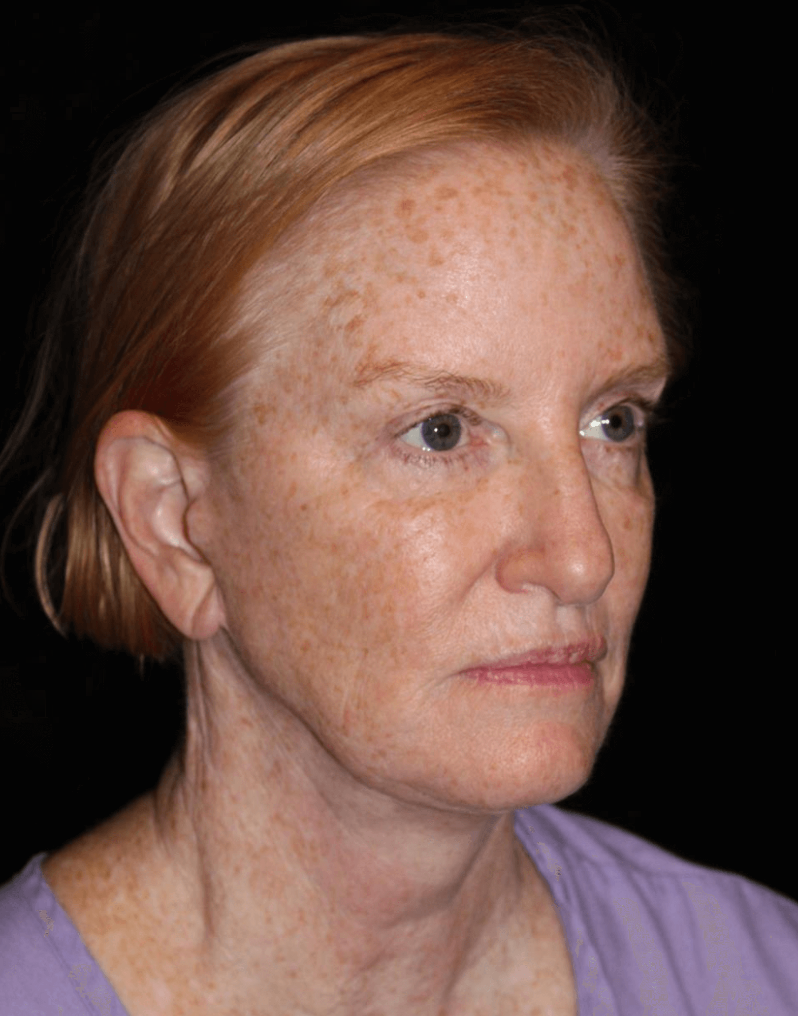 Eyelid Surgery Patient Photo - Case 17578 - after view-1
