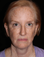 Eyelid Surgery - Case 17578 - After