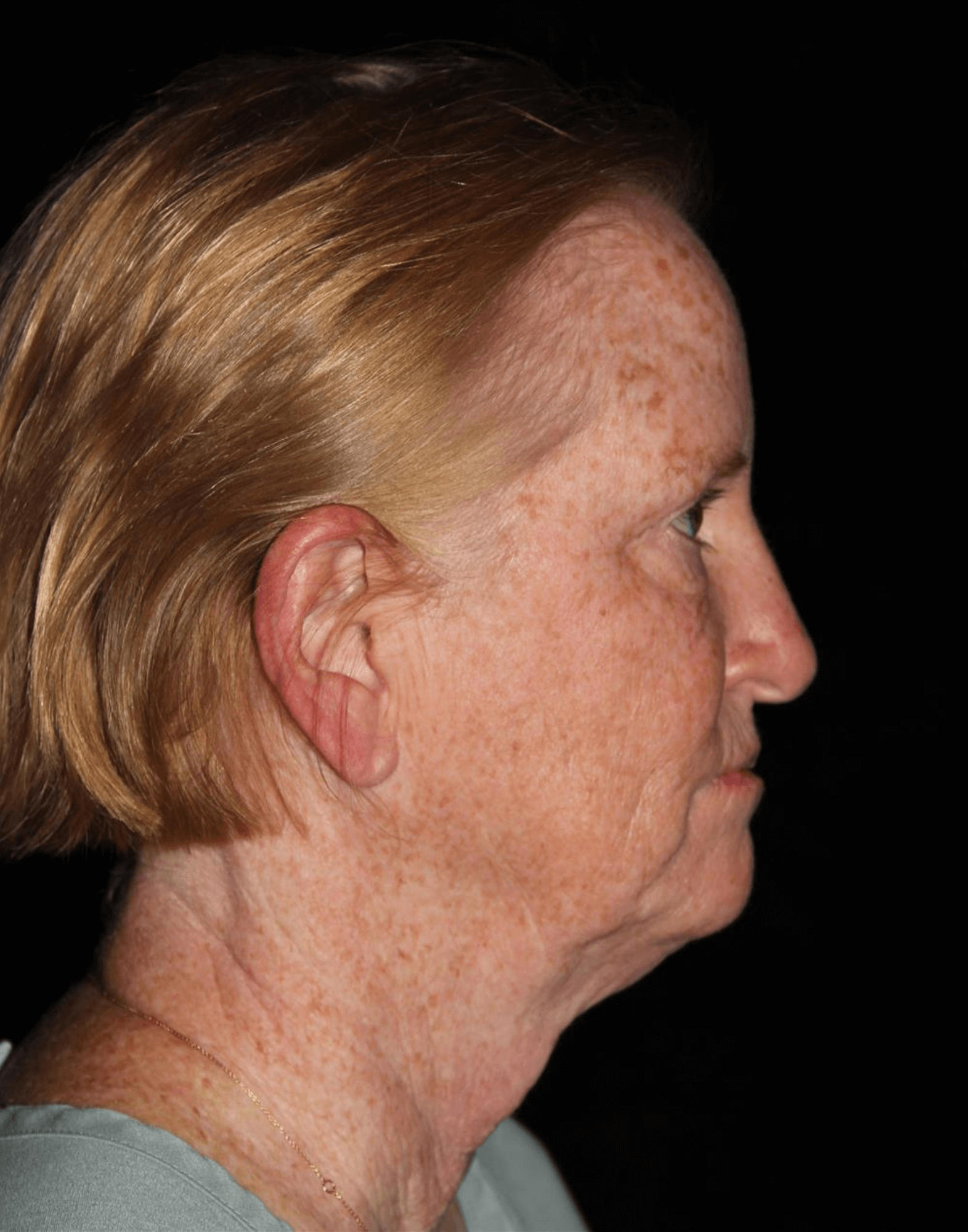 Eyelid Surgery Patient Photo - Case 17578 - before view-2