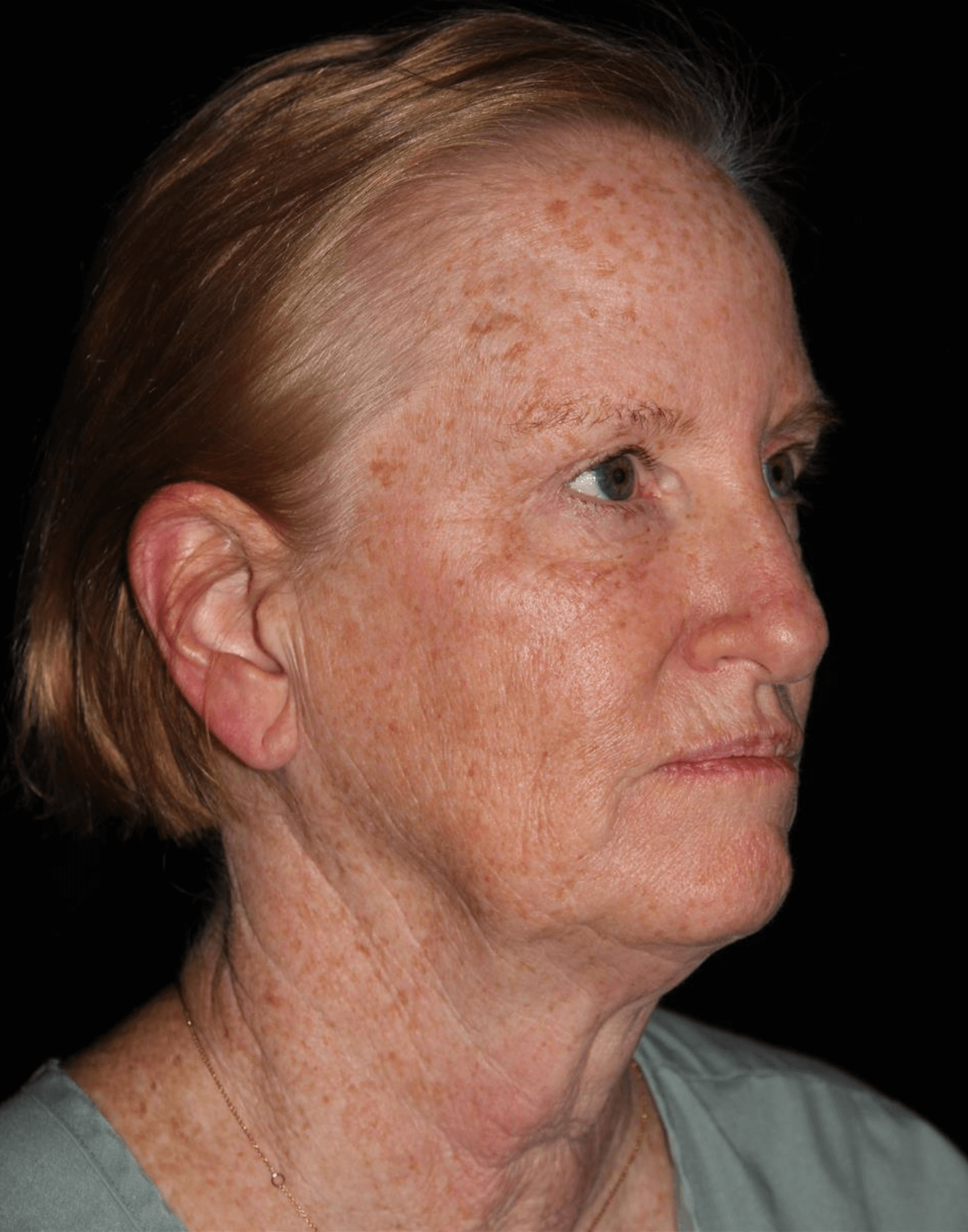 Eyelid Surgery Patient Photo - Case 17578 - before view-1