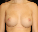 Breast Augmentation - Case 17392 - After