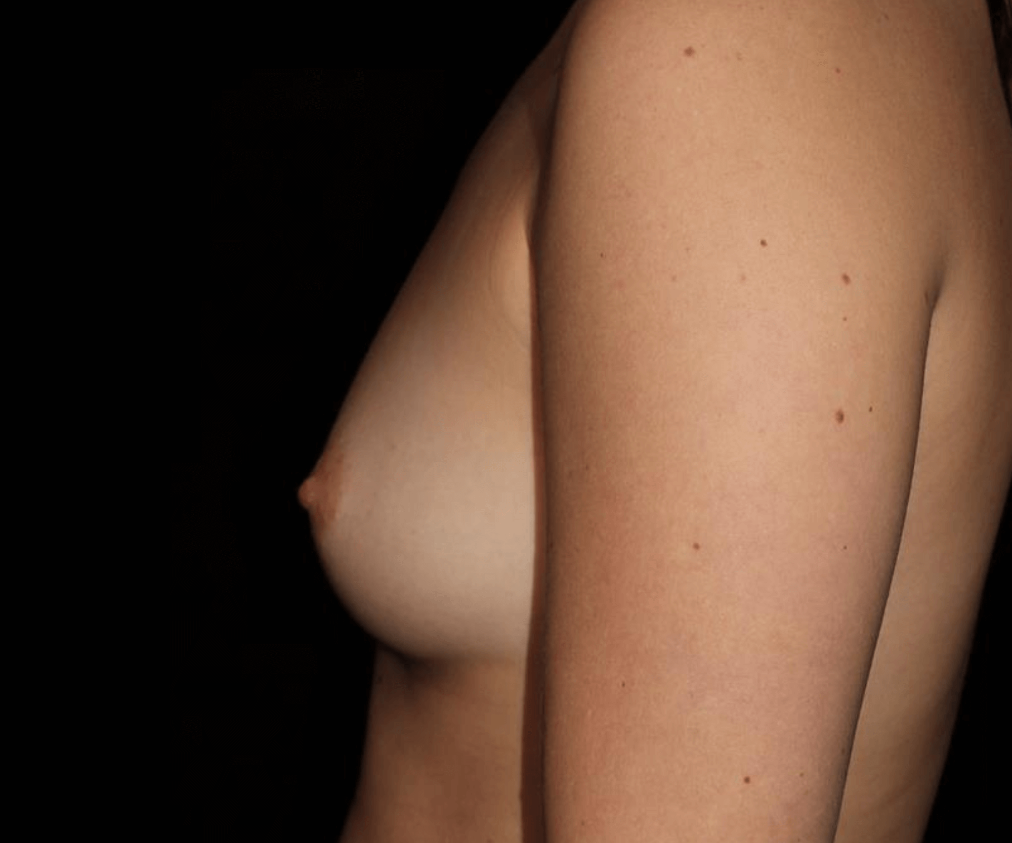 Breast Augmentation Patient Photo - Case 17392 - before view-2