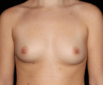 Breast Augmentation - Case 17392 - Before