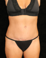 Liposuction before and after results - Nashville patient - After